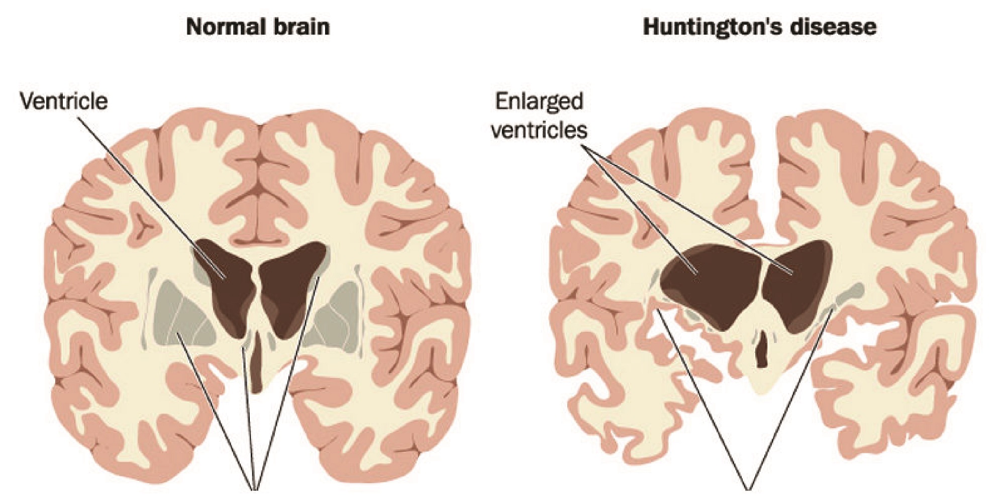 Mystery Solved: New Study Reveals How DNA Repair Genes Play a Major Role in Huntington’s Disease